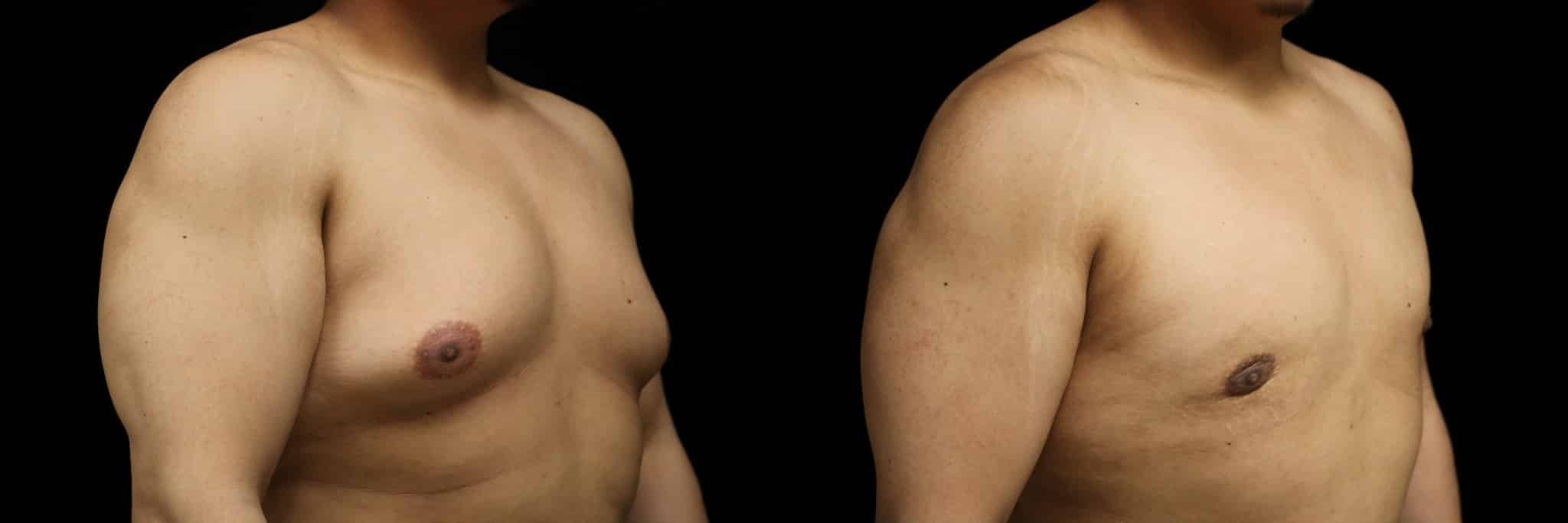 Gynecomastia Patient 7 Before & After Details