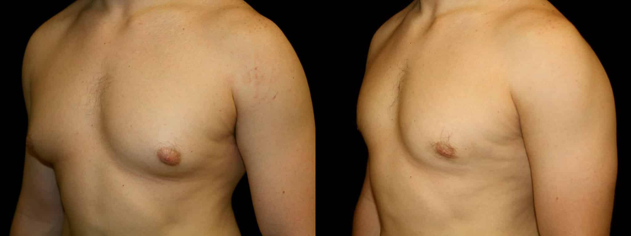 Gynecomastia Patient 15 Before & After Details