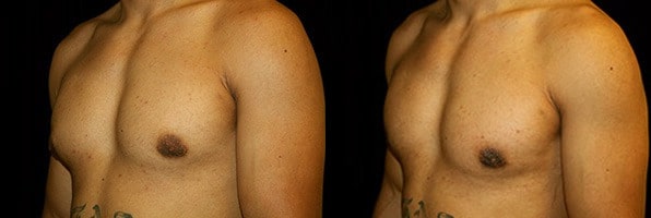 Gynecomastia Patient 17 Before & After Details