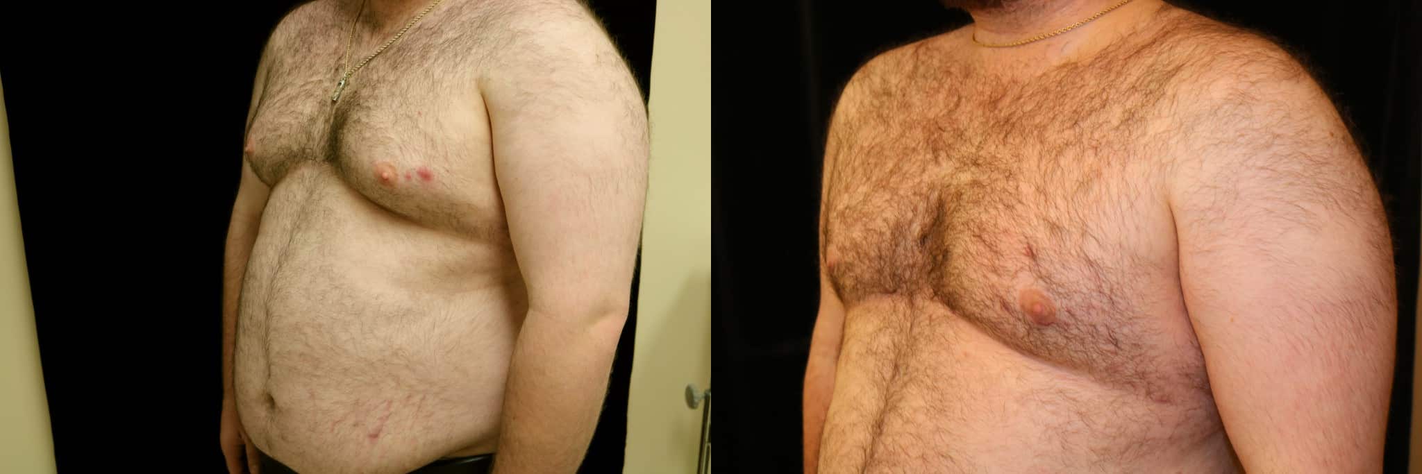 Gynecomastia Patient 21 Before & After Details