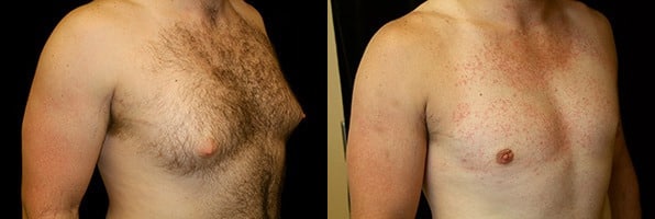 Gynecomastia Patient 6 Before & After Details