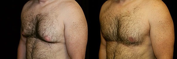 Gynecomastia Patient 15 Before & After Details