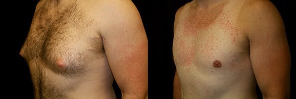 Gynecomastia Patient 6 Before & After Details