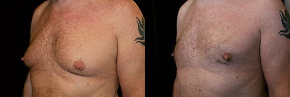 Gynecomastia Patient 7 Before & After Details