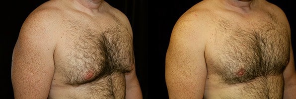 Gynecomastia Patient 15 Before & After Details