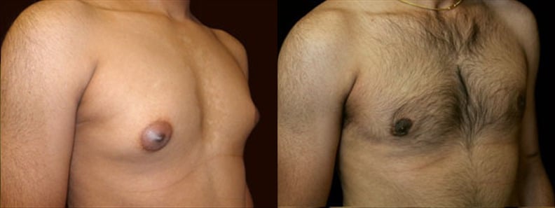 Gynecomastia Patient 15 Before & After Details