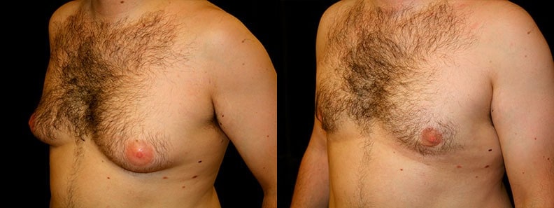 Gynecomastia Patient 8 Before & After Details