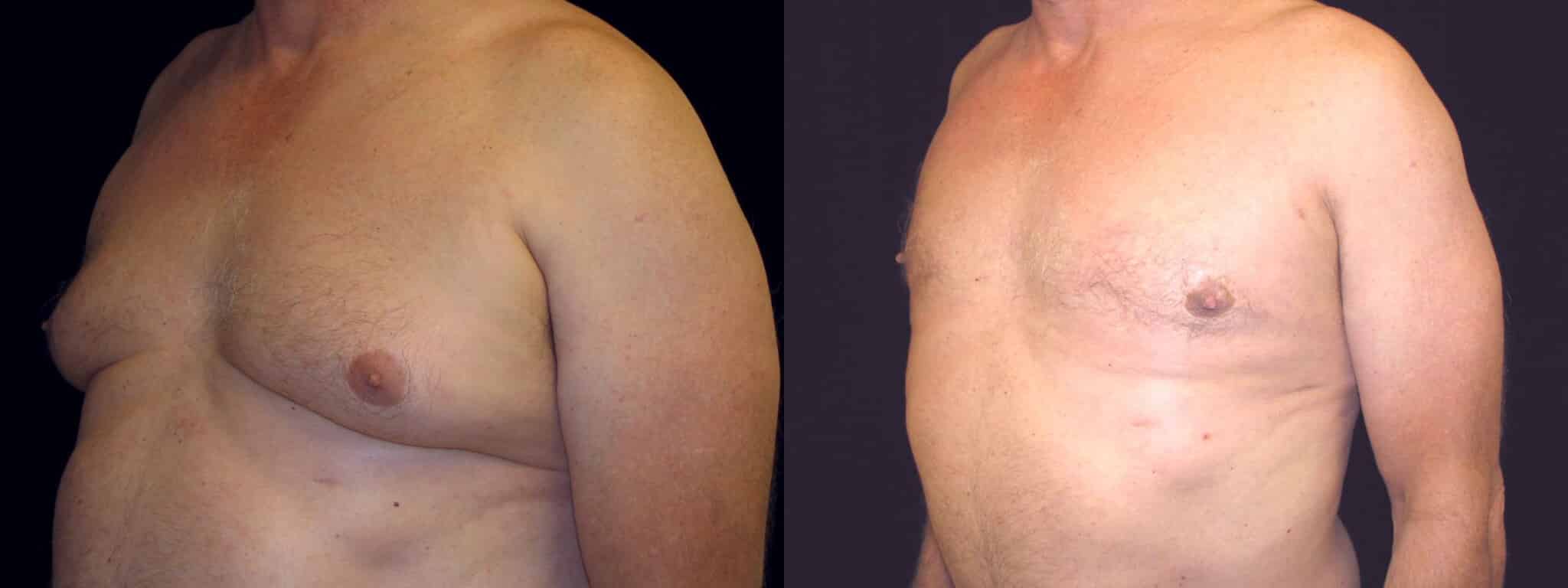 Gynecomastia Patient 21 Before & After Details