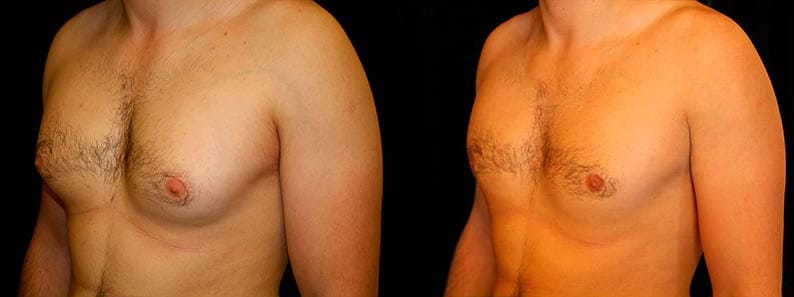 Gynecomastia Patient 17 Before & After Details