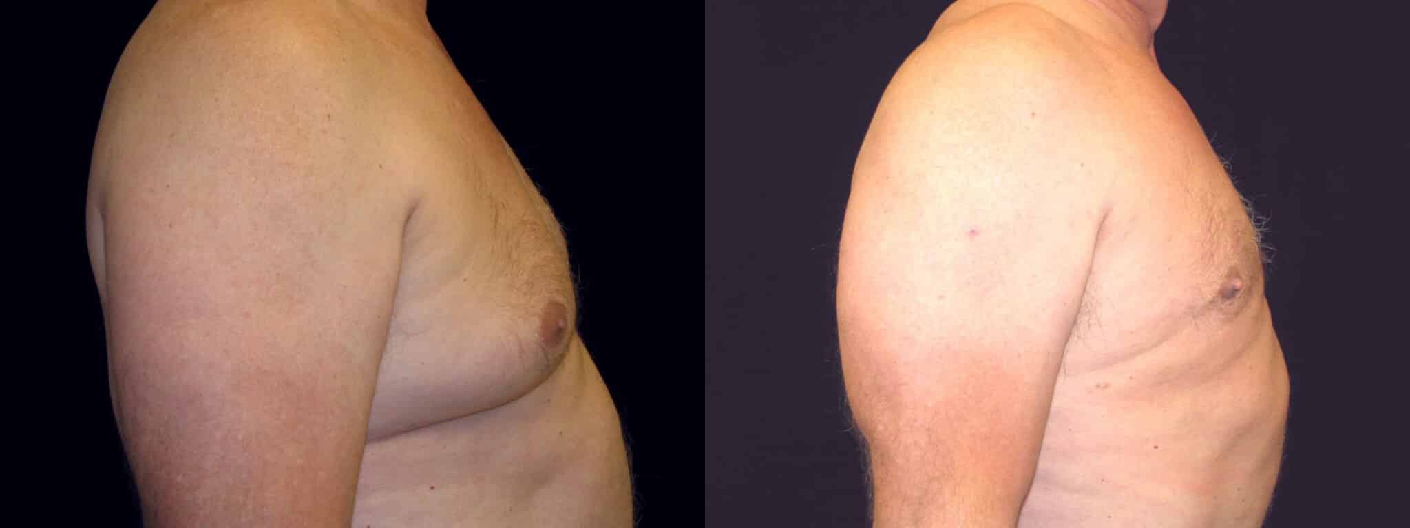 Gynecomastia Patient 21 Before & After Details