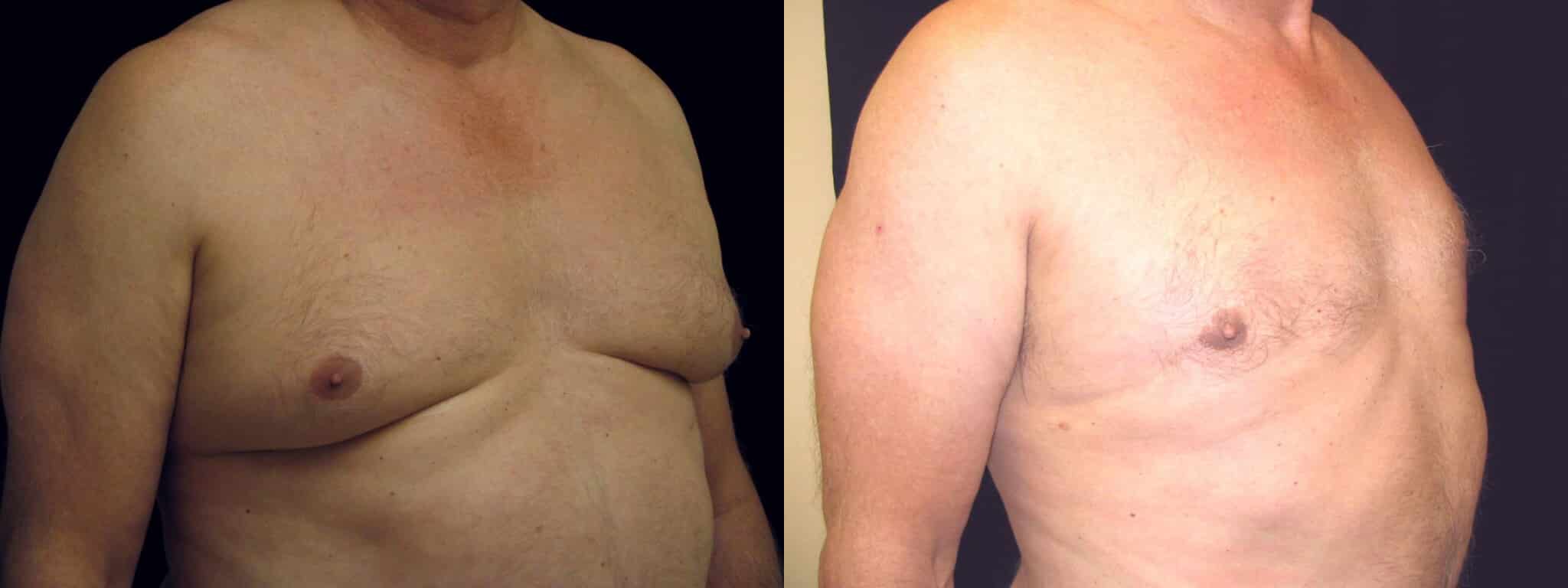 Gynecomastia Patient 21 Before & After Details