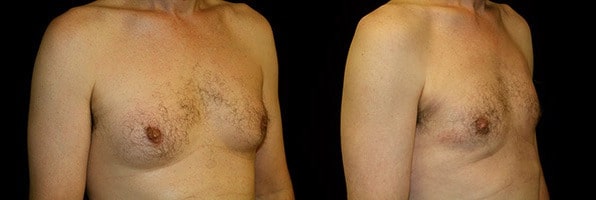 Gynecomastia Patient 8 Before & After Details