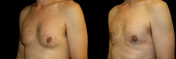 Gynecomastia Patient 8 Before & After Details