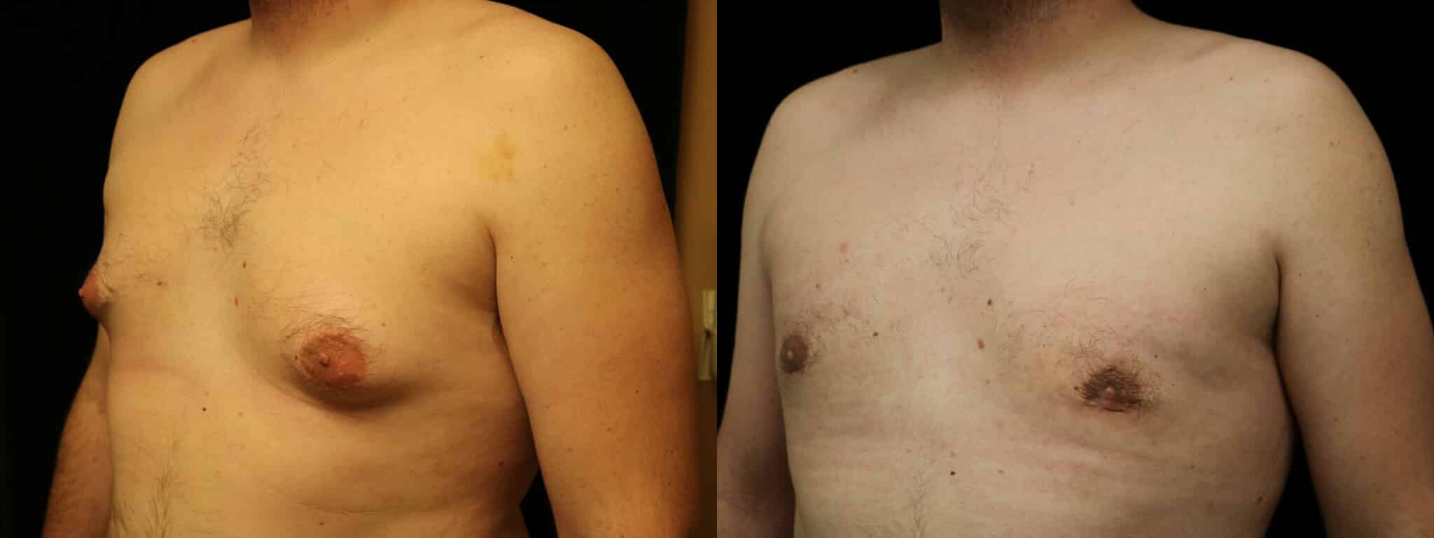 Gynecomastia Patient 15 Before & After Details