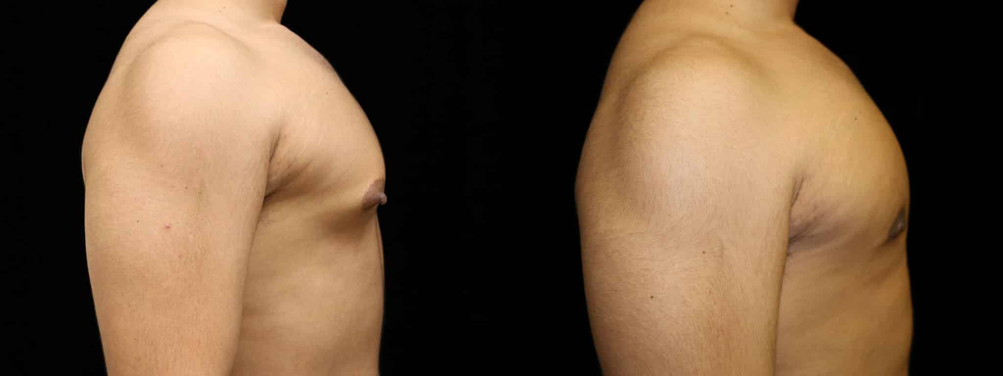 Gynecomastia Patient 15 Before & After Details