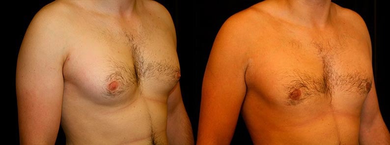 Gynecomastia Patient 17 Before & After Details