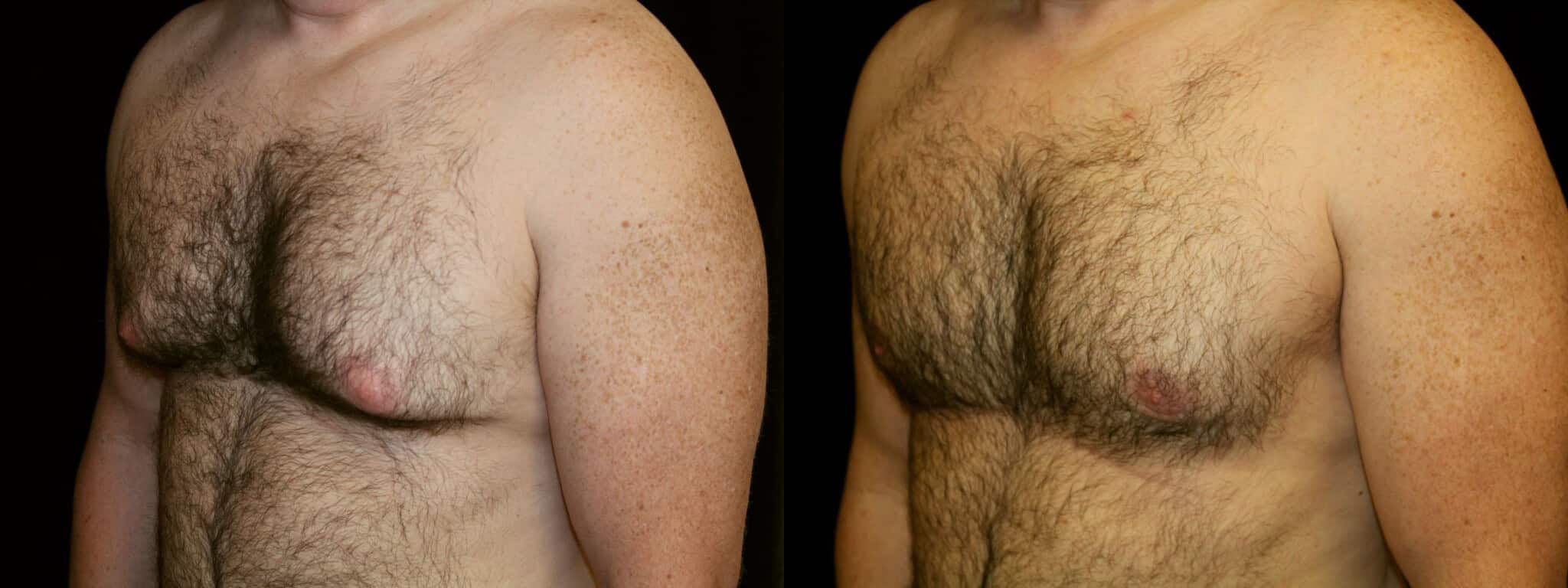 Gynecomastia Patient 6 Before & After Details