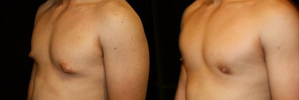 Gynecomastia Patient 13 Before & After Details