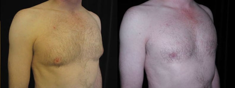 Gynecomastia Patient 4 Before & After Details