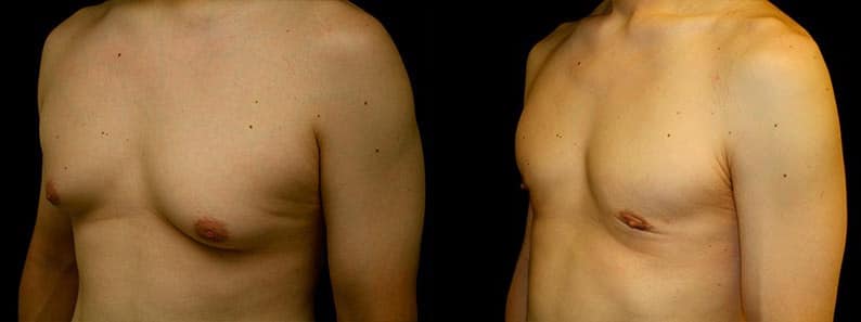 Gynecomastia Patient 18 Before & After Details