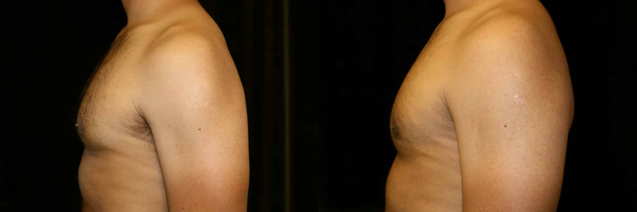 Gynecomastia Patient 15 Before & After Details