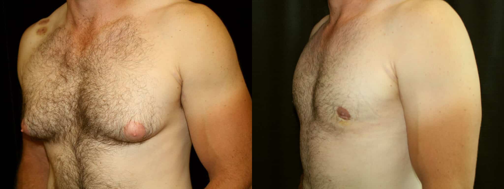 Gynecomastia Patient 20 Before & After Details