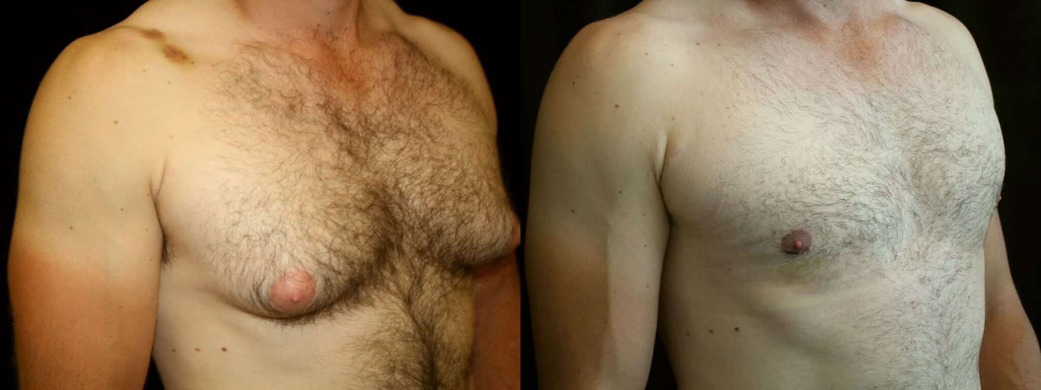 Gynecomastia Patient 20 Before & After Details