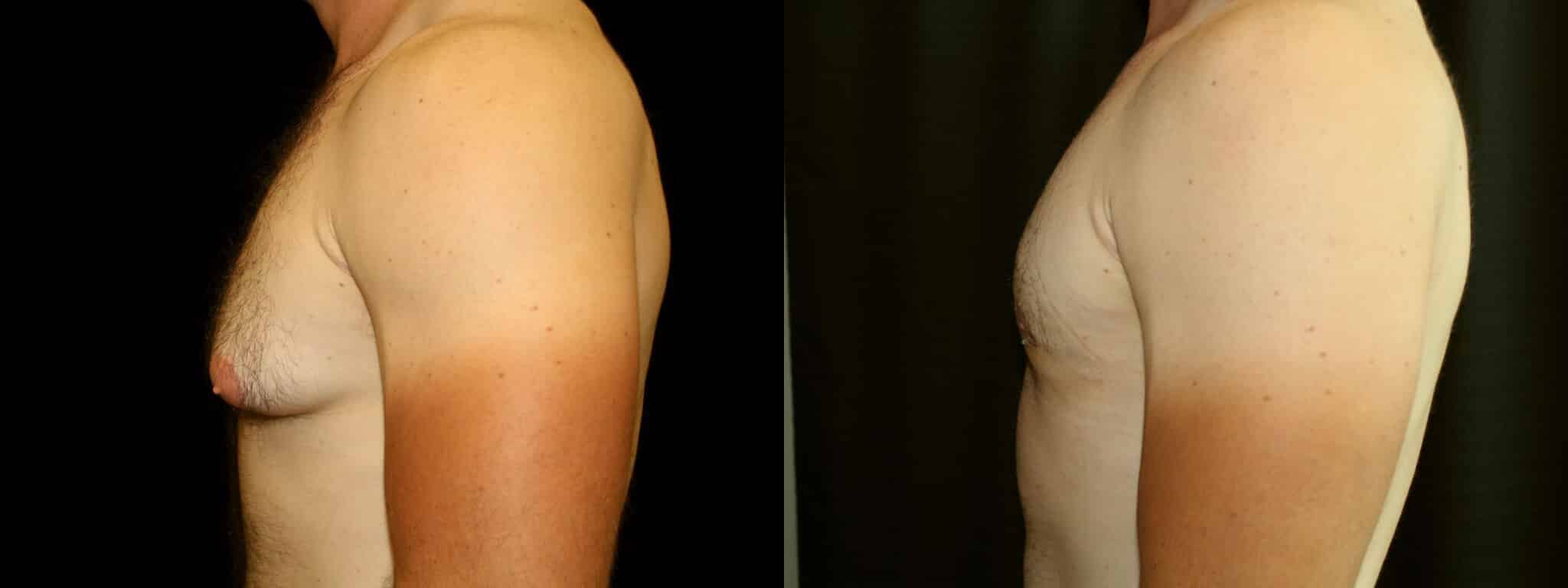 Gynecomastia Patient 20 Before & After Details