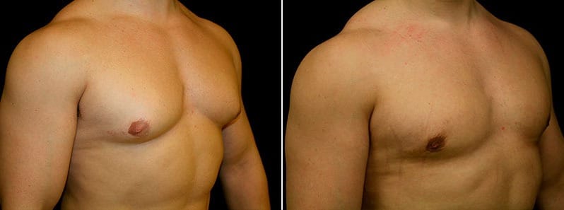 Gynecomastia Patient 20 Before & After Details