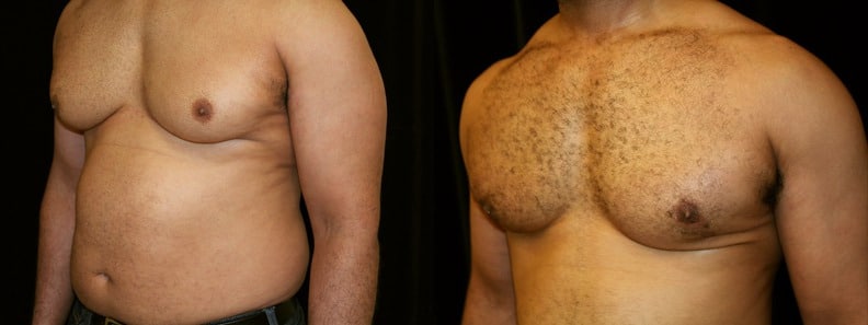 Gynecomastia Patient 1 Before & After Details