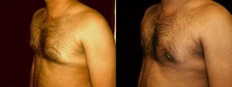 Gynecomastia Patient 5 Before & After Details