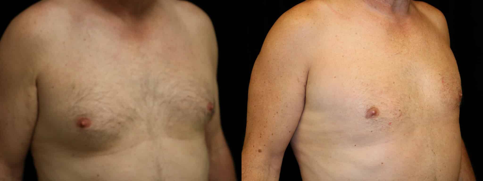 Gynecomastia Patient 13 Before & After Details