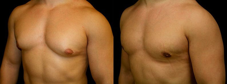 Gynecomastia Patient 20 Before & After Details