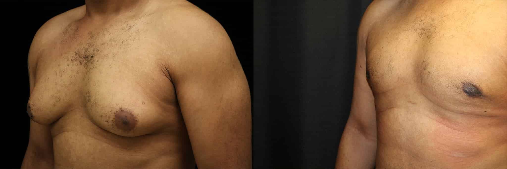 Gynecomastia Patient 4 Before & After Details