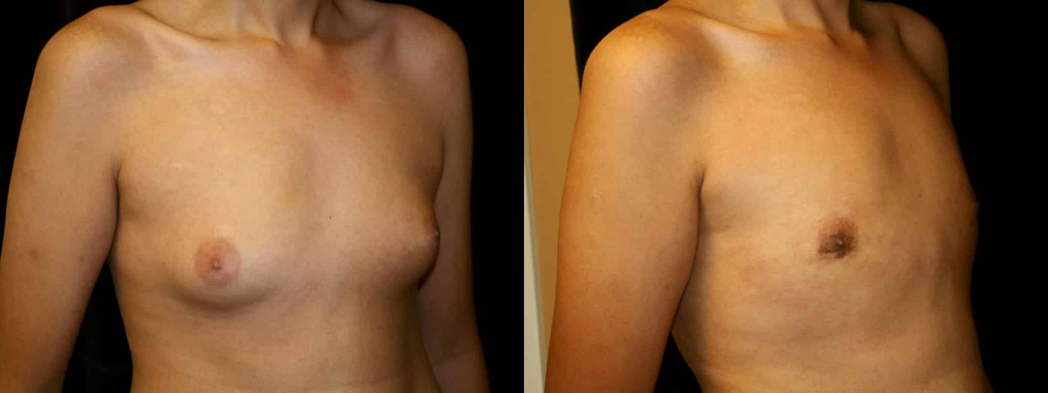 Gynecomastia Patient 13 Before & After Details