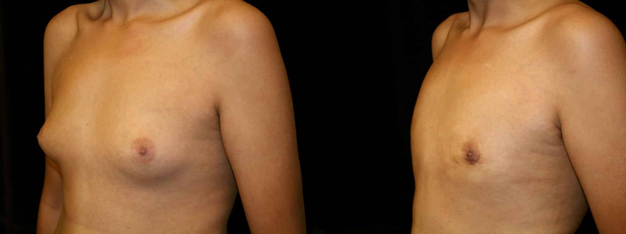 Gynecomastia Patient 13 Before & After Details