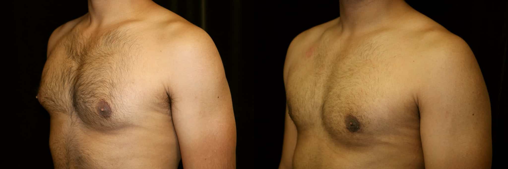 Gynecomastia Patient 15 Before & After Details