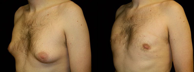 Gynecomastia Patient 2 Before & After Details