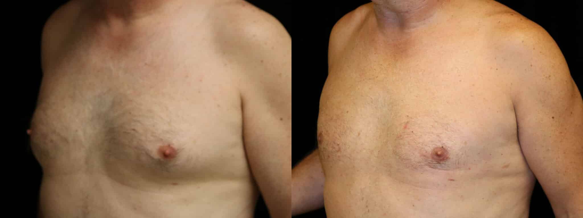 Gynecomastia Patient 13 Before & After Details