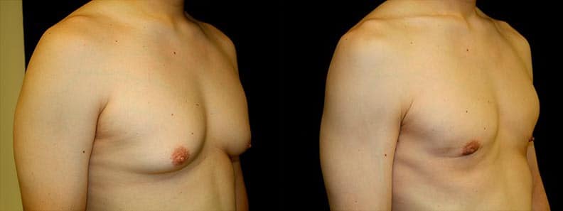 Gynecomastia Patient 18 Before & After Details