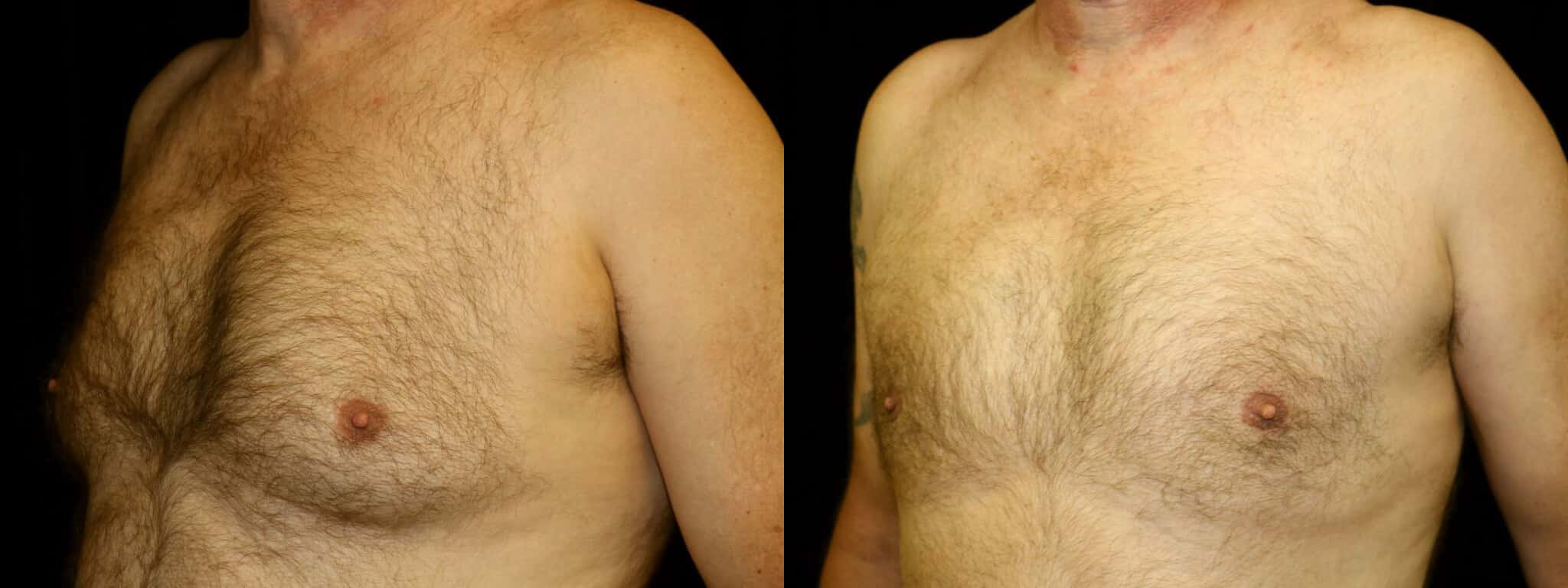 Gynecomastia Patient 15 Before & After Details