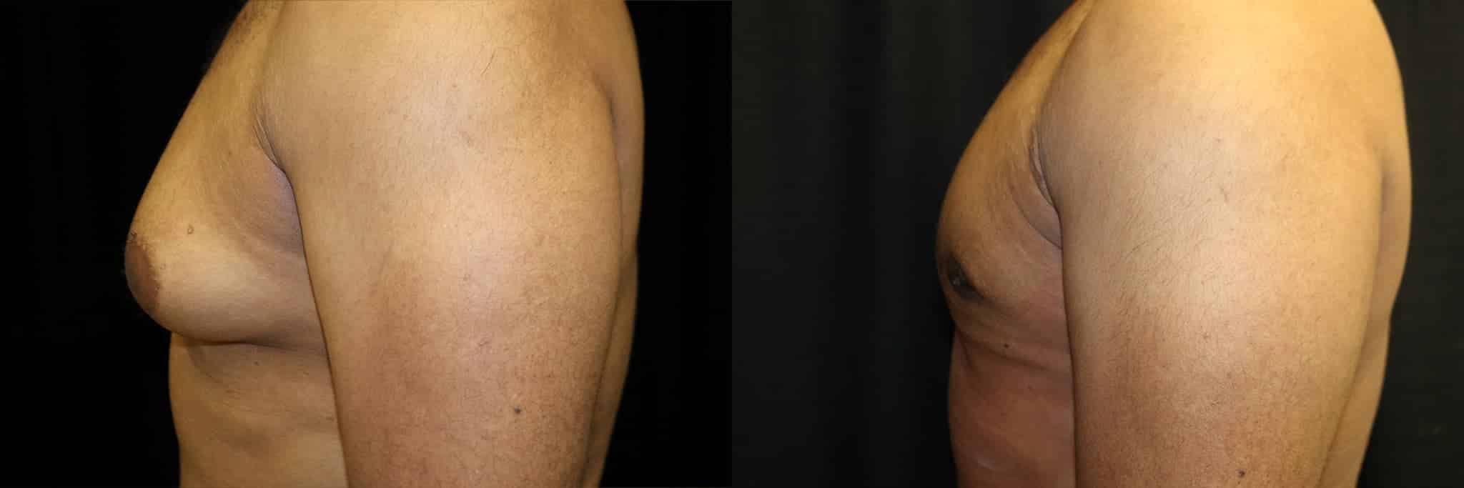 Gynecomastia Patient 4 Before & After Details