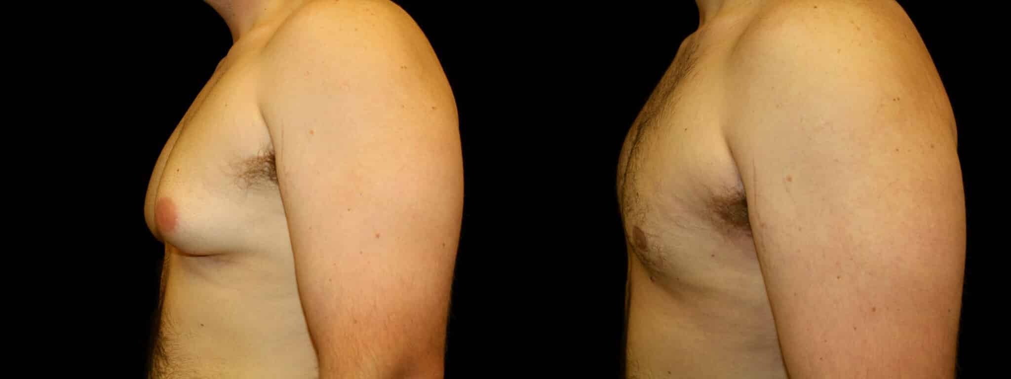 Gynecomastia Patient 6 Before & After Details