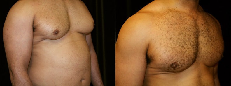 Gynecomastia Patient 1 Before & After Details