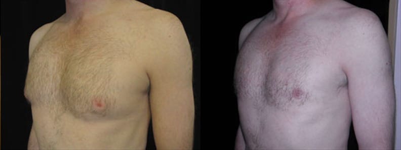 Gynecomastia Patient 4 Before & After Details