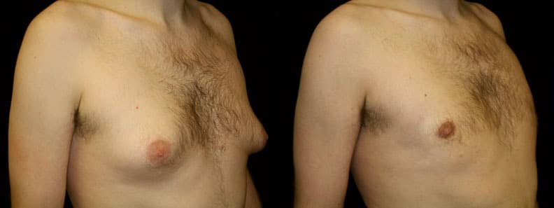 Gynecomastia Patient 2 Before & After Details