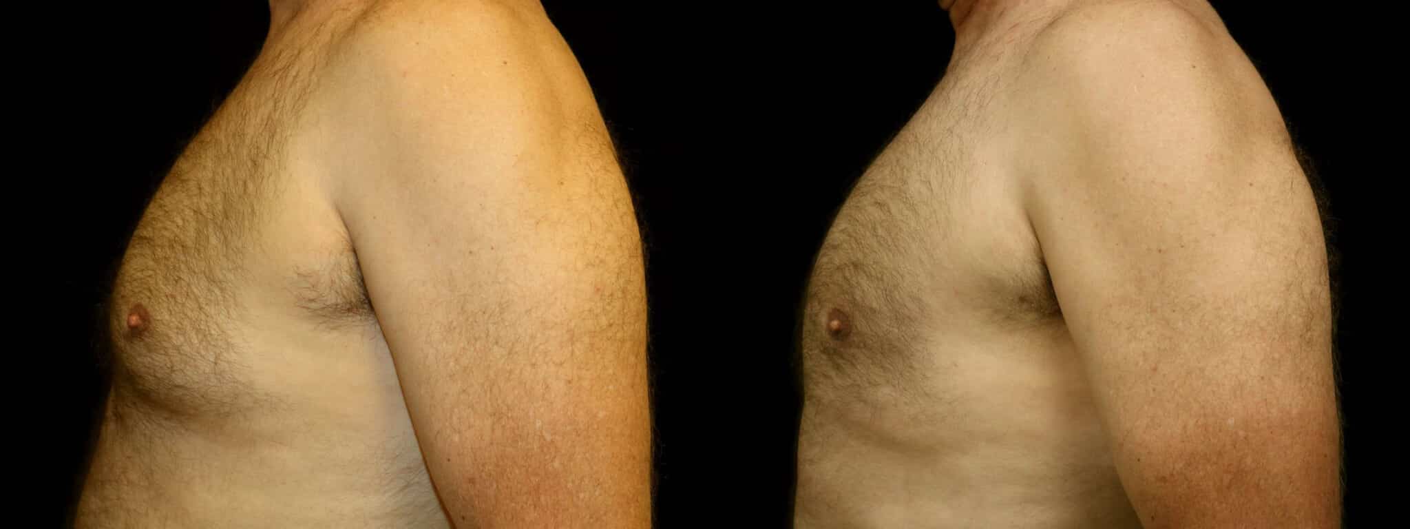 Gynecomastia Patient 15 Before & After Details