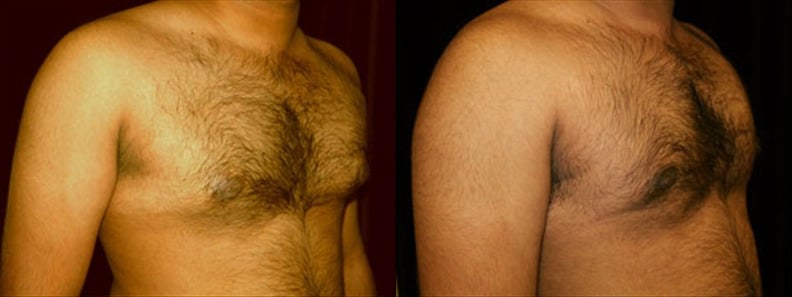 Gynecomastia Patient 5 Before & After Details