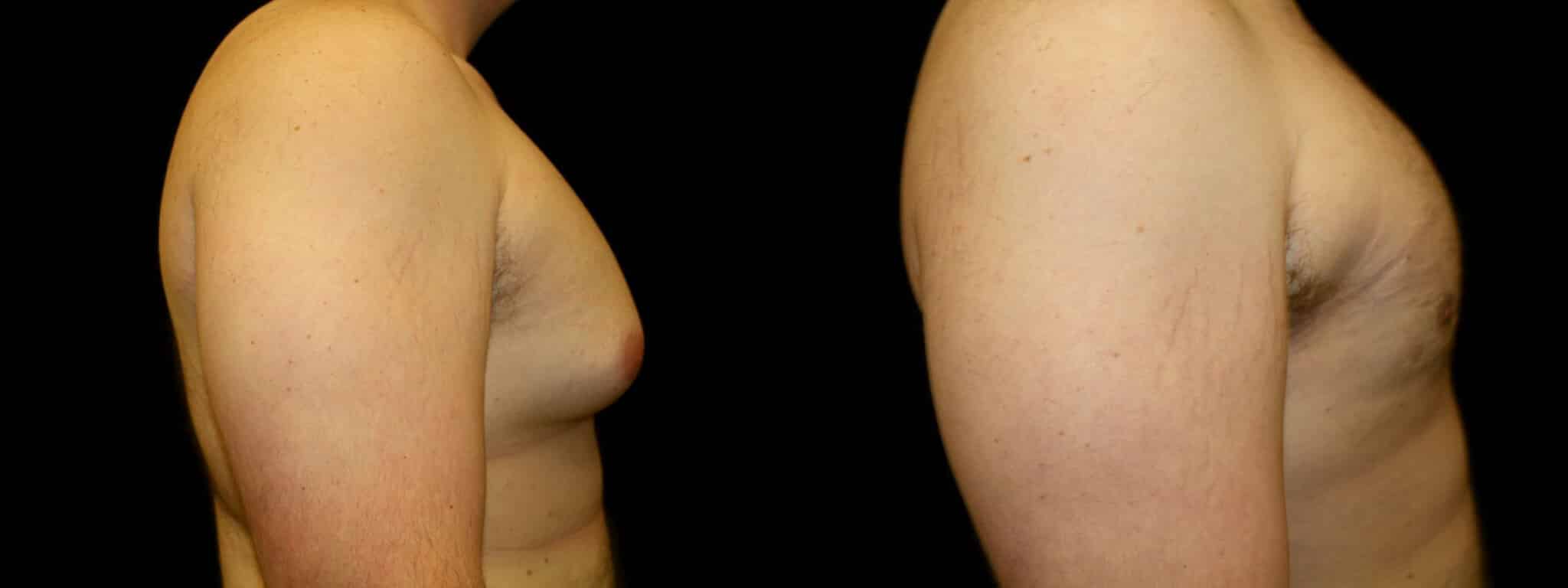 Gynecomastia Patient 6 Before & After Details