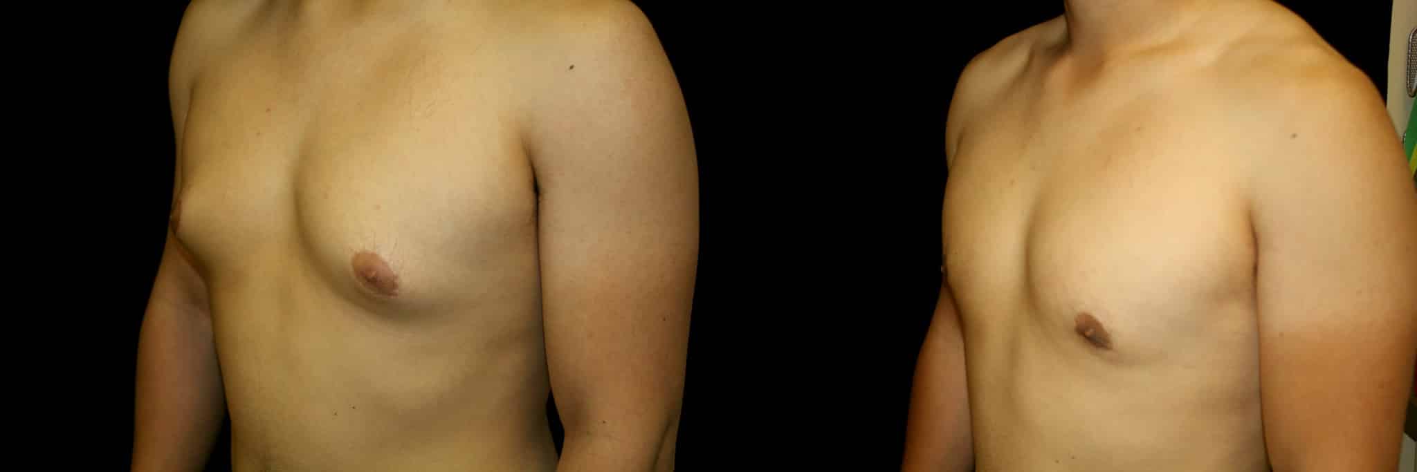 Gynecomastia Patient 6 Before & After Details